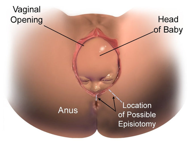 Episiotomy Is it Really Needed